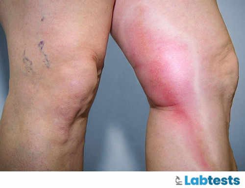 Phlebitis on the Leg image