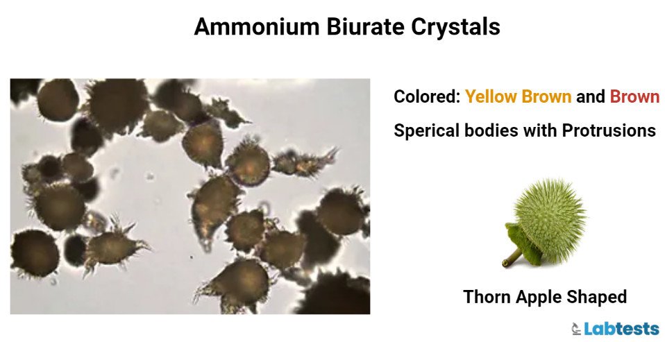 Ammonium biurate crystals in urine image