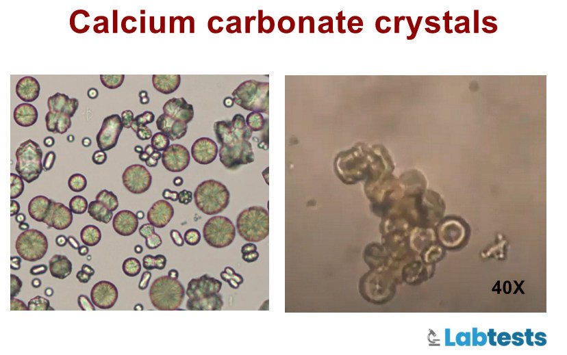 Calcium carbonate crystals in urine