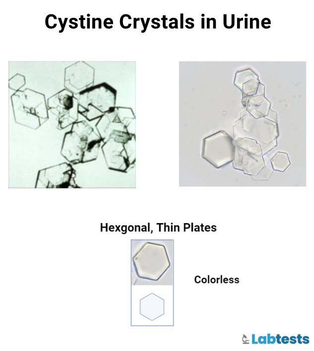 Cystine crystals of hexagonal shape  in urine image