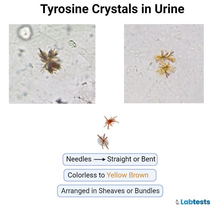 Tyrosine Crystals in Urine picture
