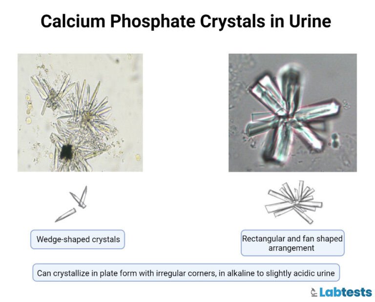 Calcium phosphate crystals in Urine