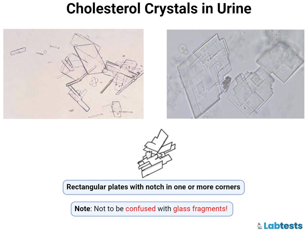 Cholesterol crystals in urine picture