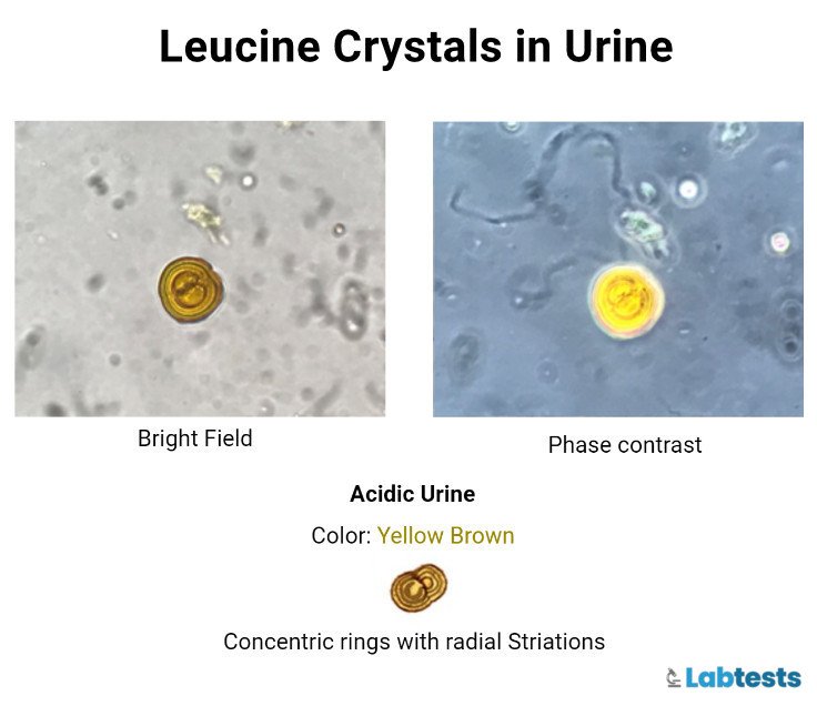 leucine crystals in urine image