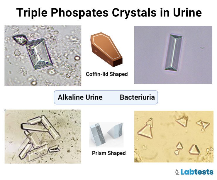 Triple phosphate crystals (Struvite, Magnesium ammonium phosphate) in urine