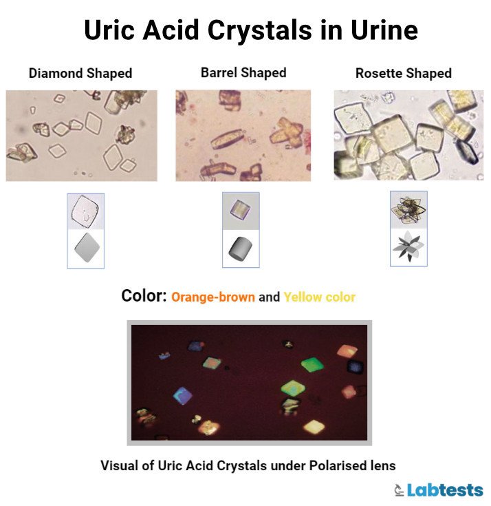 Uric acid crystals in urine
