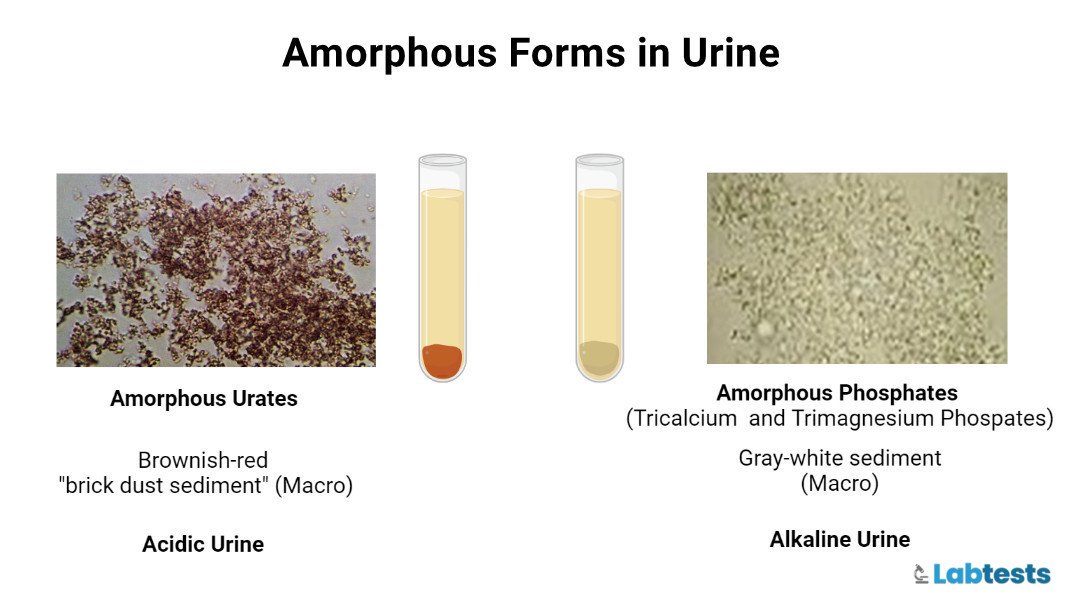 Amorphous forms (urates and phosphates) in urine image picture