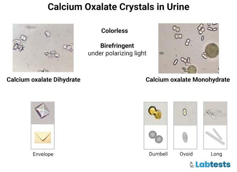 calcium oxalate monohydrate and dihydrate crystals in urine